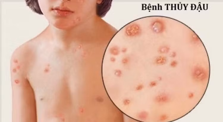 Ăn uống đúng cách sẽ giúp người bệnh thuỷ đậu mau hồi phục, tránh biến chứng - Ảnh minh hoạ