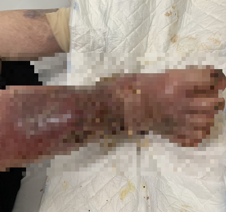 Suy tuyến thượng thận, nhiễm trùng bàn chân nặng vì lạm dụng thuốc giảm đau ảnh 1