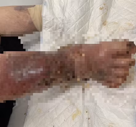 Suy tuyến thượng thận, nhiễm trùng bàn chân nặng vì lạm dụng thuốc giảm đau ảnh 1 Suy tuyến thượng thận, nhiễm trùng bàn chân nặng vì lạm dụng thuốc giảm đau ảnh 1