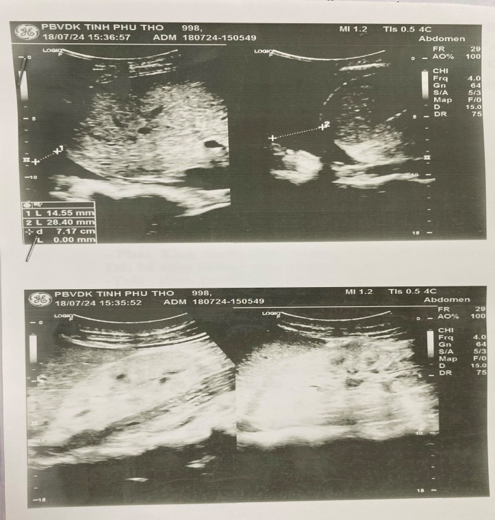 Kết quả siêu âm cho thấy 2 thận người bệnh đã teo nhỏ, có dịch ổ bụng và dịch màng phổi hai bên - Ảnh: BVCC