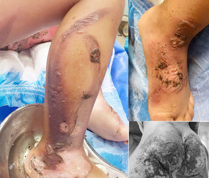 Hình ảnh tổn thương của bệnh nhi khi nhập viện