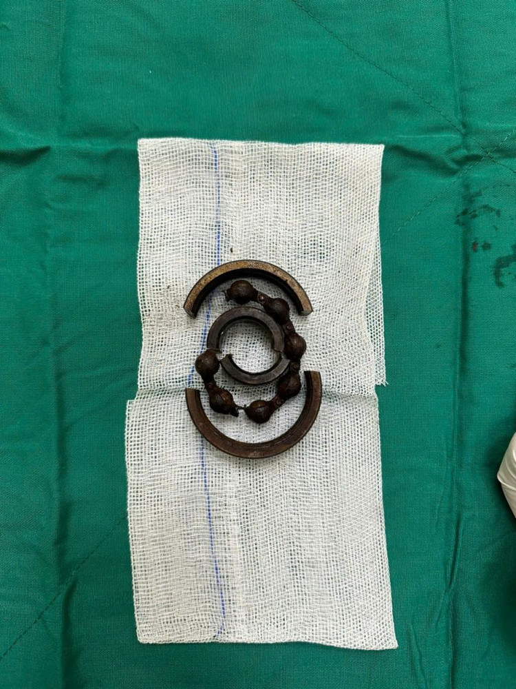 Vòng bi bạc đạn kích thước 7cm được cắt lấy ra khỏi dương vật - Ảnh: BVCC