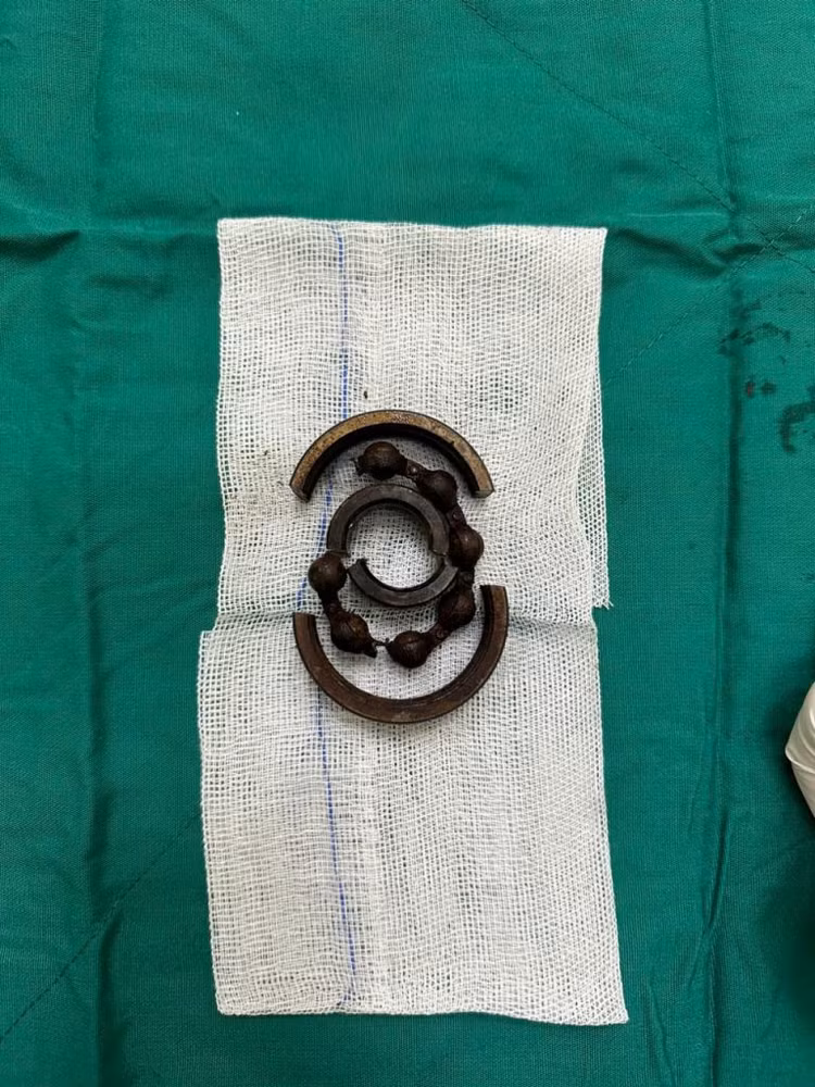 Vòng bi bạc đạn kích thước 7cm được cắt lấy ra khỏi dương vật - Ảnh: BVCC