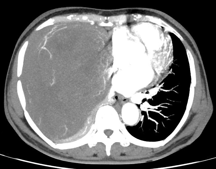 Tách thành công khối U nặng 2kg choán hết lồng ngực, đè xẹp phổi.... ảnh 1 Tách thành công khối U nặng 2kg choán hết lồng ngực, đè xẹp phổi.... ảnh 1