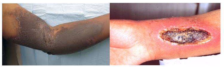 Da hoại tử do thoát mạch hóa chất - ảnh BSCC