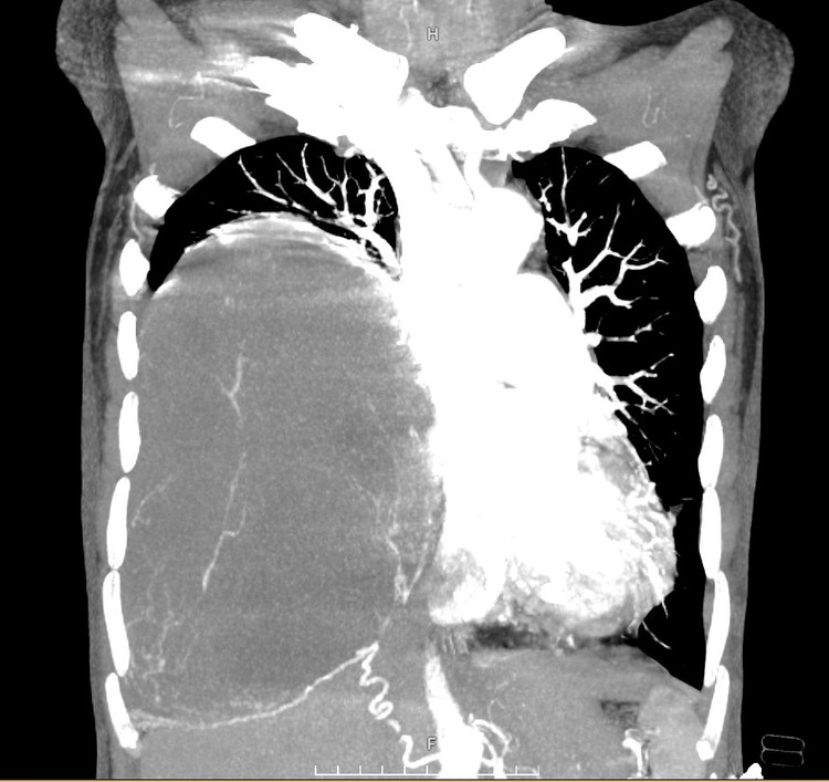 Tách thành công khối U nặng 2kg choán hết lồng ngực, đè xẹp phổi.... ảnh 2