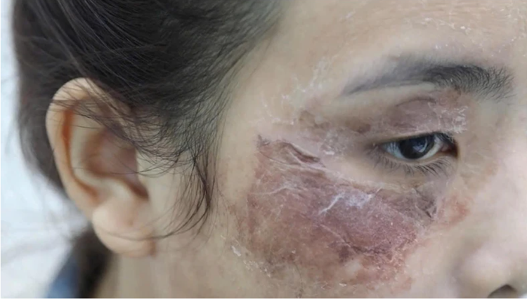 Một trường hợp hỏng da khác do peel da tại nhà - Ảnh BVCC