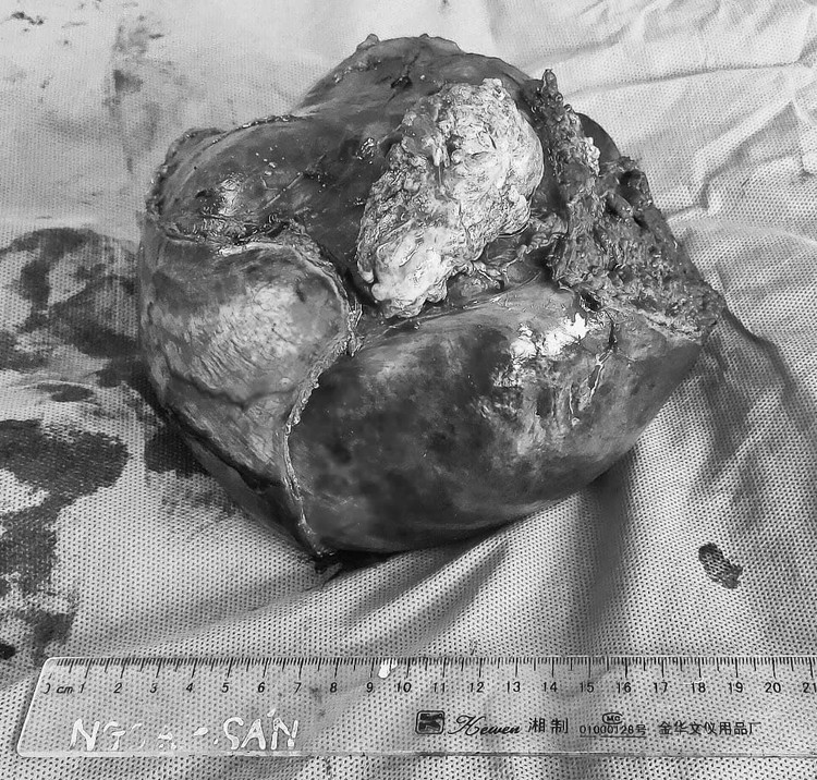 Khối u gan khổng lồ được cắt bỏ thành công - Ảnh BVCC