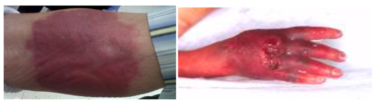 Tổn thương cánh tay do thoát mạch hóa chất - ảnh BSCC