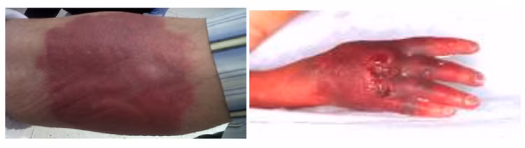 Tổn thương cánh tay do thoát mạch hóa chất - ảnh BSCC