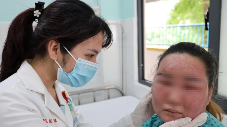 Khuôn mặt bệnh nhân sau 3 ngày lột trắng da tại nhà - Ảnh BVCC