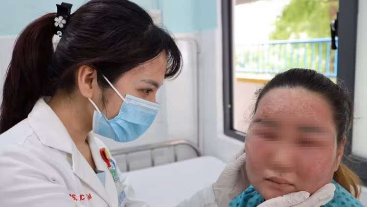 Khuôn mặt bệnh nhân sau 3 ngày lột trắng da tại nhà - Ảnh BVCC