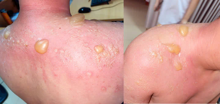 Hình ảnh tổn thương của người bệnh