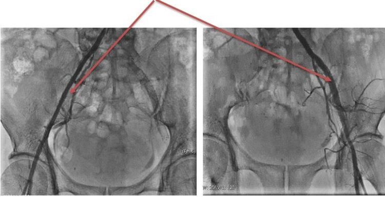 Động mạch chậu 2 bên thông tốt sau can thiệp
