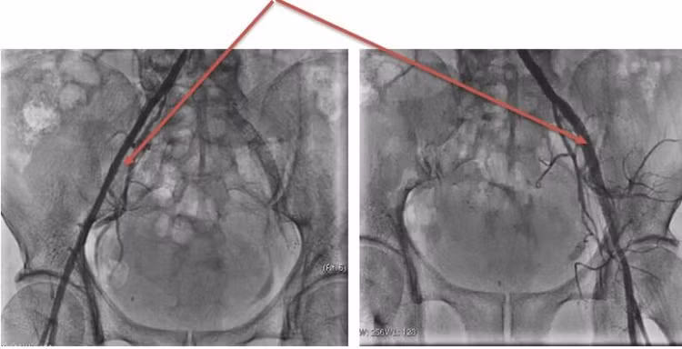 Động mạch chậu 2 bên thông tốt sau can thiệp