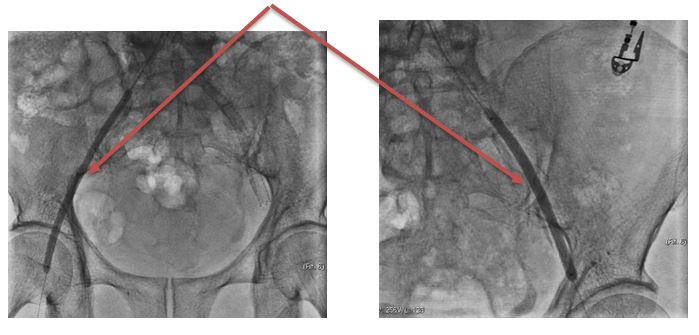 Can thiệp nong bóng động mạch chậu 2 bên