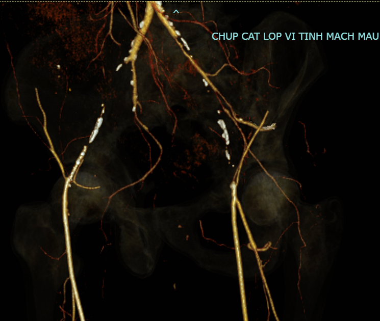 Hình ảnh động mạch chậu bị tắc