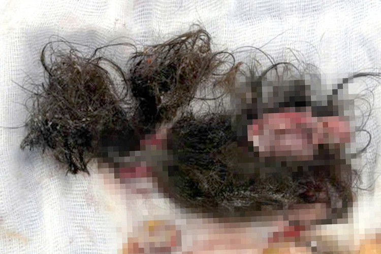 Khối u chứa đầy tóc, da, xương... được lấy bỏ - Ảnh BVCC Khối u chứa đầy tóc, da, xương... được lấy bỏ - Ảnh BVCC