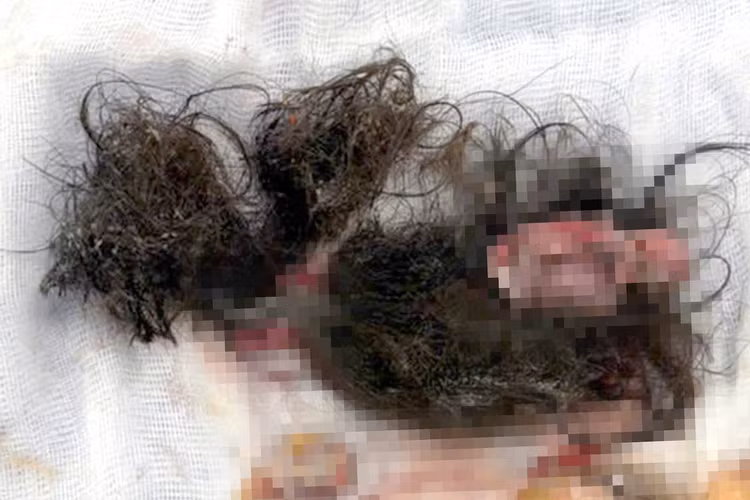 Khối u chứa đầy tóc, da, xương... được lấy bỏ - Ảnh BVCC