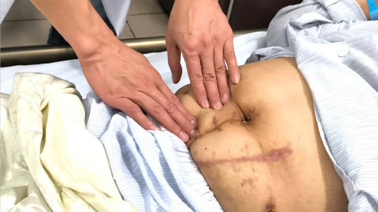 Bệnh nhân đã trải qua nhiều lần phẫu thuật - Ảnh BVCC