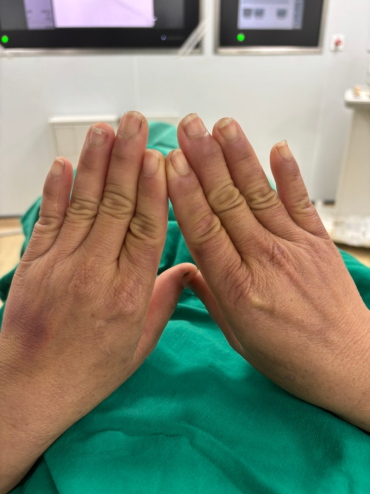Hình ảnh bàn tay của người bệnh bị tím tái, ngón tay trắng nhợt mỗi khi chạm vào nước - Ảnh BVCC