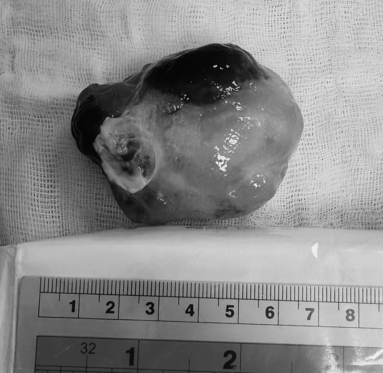 Khối u nhầy khổng lồ ở tim được lấy ra - Ảnh BVCC