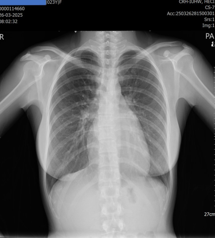 Xquang ngực thẳng cho thấy hình ảnh bóng tim to - Ảnh BVCC