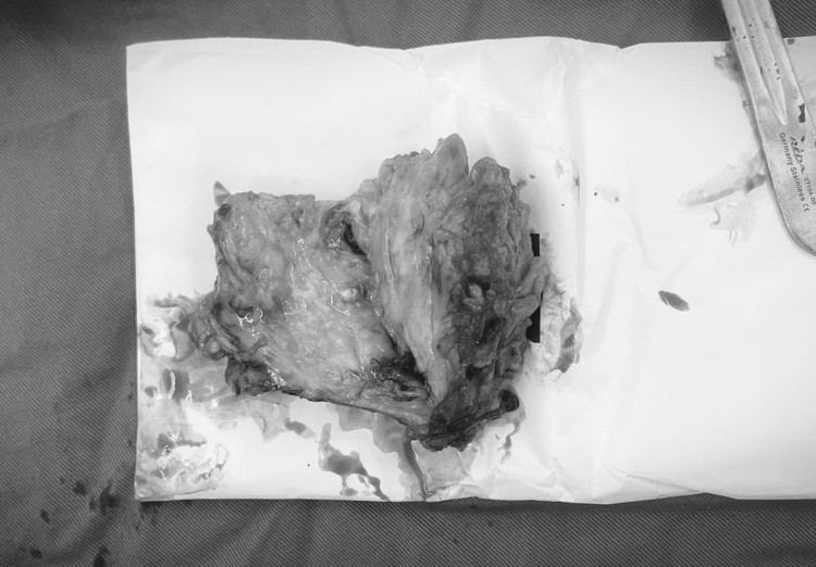 Khối u được cắt bỏ - Ảnh BVCC