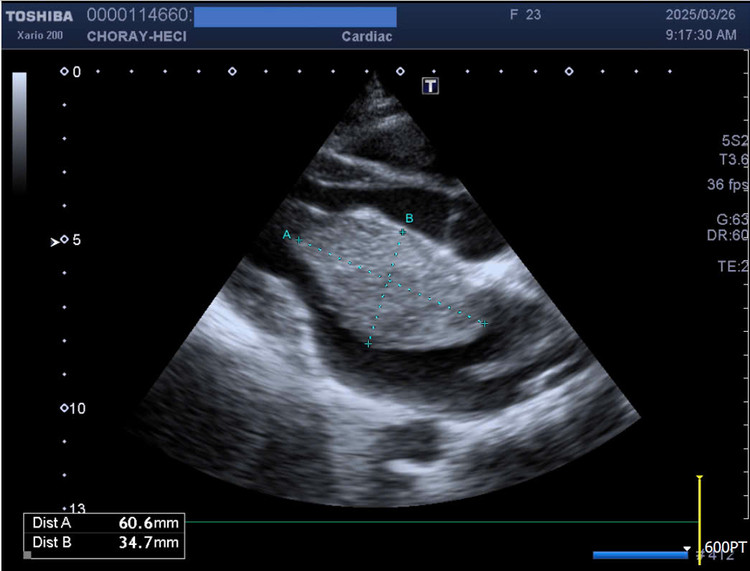 Hình siêu âm tim ghi nhận khối u to, kích thước 33x57mm gây tắc nghẽn cơ học tại van 2 lá - Ảnh BVCC