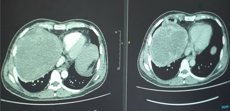 Kết quả phim chụp khối u - Ảnh BVCC