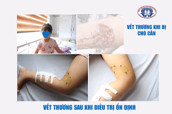Hình ảnh vết thương bị chó cắn sau khi được xử lí nhiễm trùng