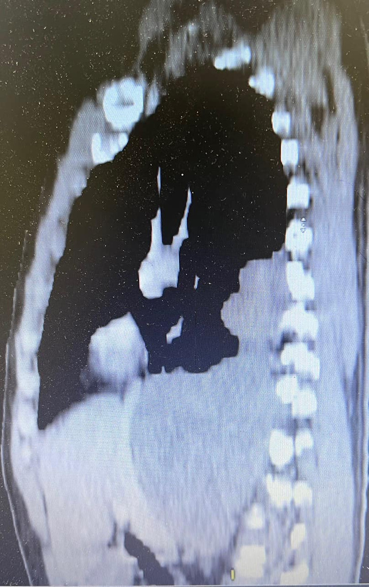 Đau tức bụng nhiều ngày quý ông 43 tuổi phát hiện u trung thất khổng lồ