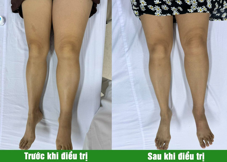 Phương pháp trị liệu “phù tay voi”, “phù chân voi” sau điều trị ung thư ảnh 1