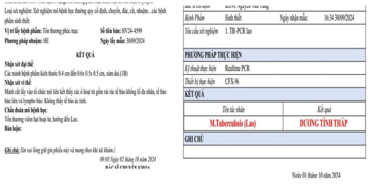 Phiếu xét nghiệm bệnh nhân dương tính với lao màng bụng - Ảnh BVCC