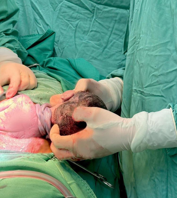 Bé bị rau quấn cổ 3 vòng