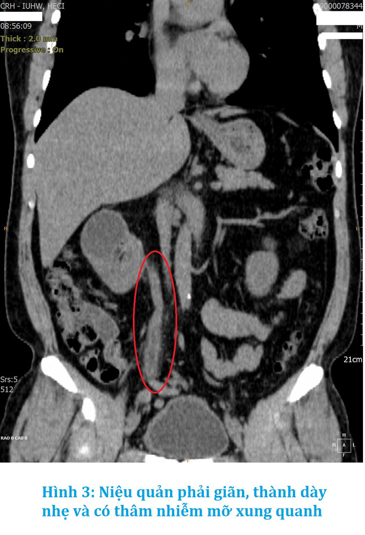 7 năm điều trị nhiễm trùng đường niệu không khỏi bất ngờ phát hiện lao