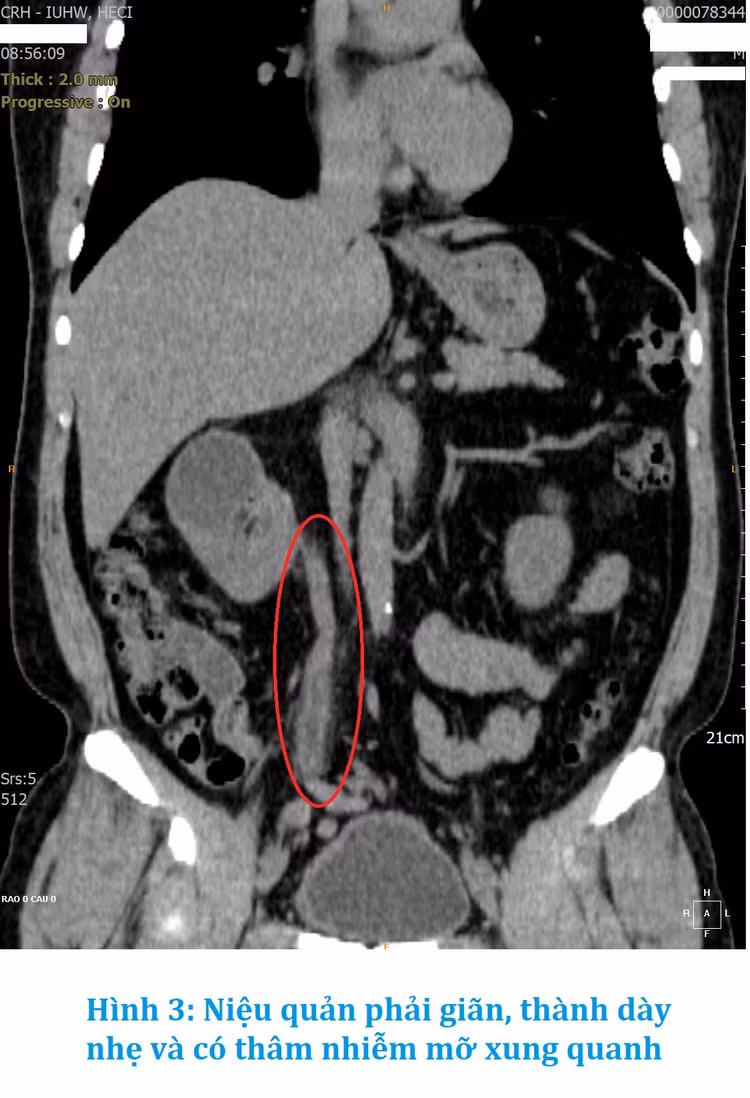 7 năm điều trị nhiễm trùng đường niệu không khỏi bất ngờ phát hiện lao