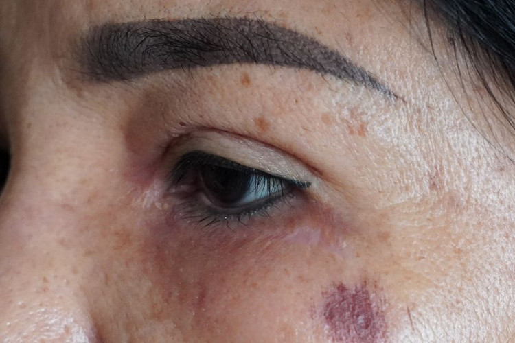 Bị lừa tiêm filler tại nhà nghỉ, 2 người bị tai biến và mất sạch tài sản