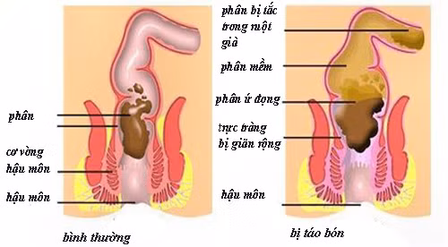 Biểu hiện của táo bón