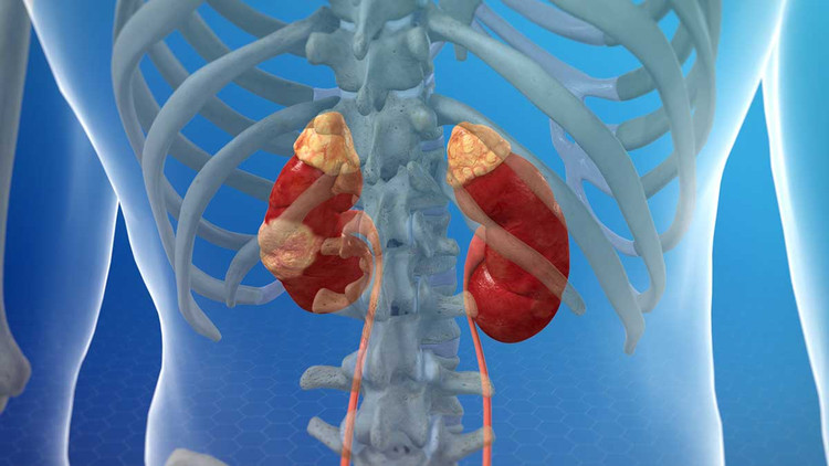 Biểu hiện ung thư thận