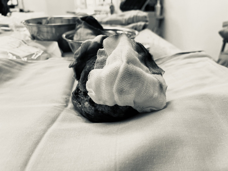 Khối u quái đã được cắt bỏ.