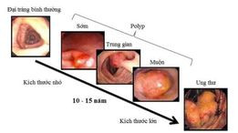 Thời gian polyp đại tràng biến chuyển ung thư - Ảnh minh họa