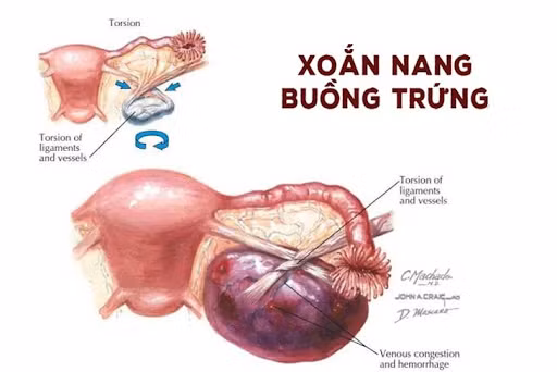 Xoắn buồng trứng dễ đe dọa tính mạng bệnh nhân - Ảnh minh họa