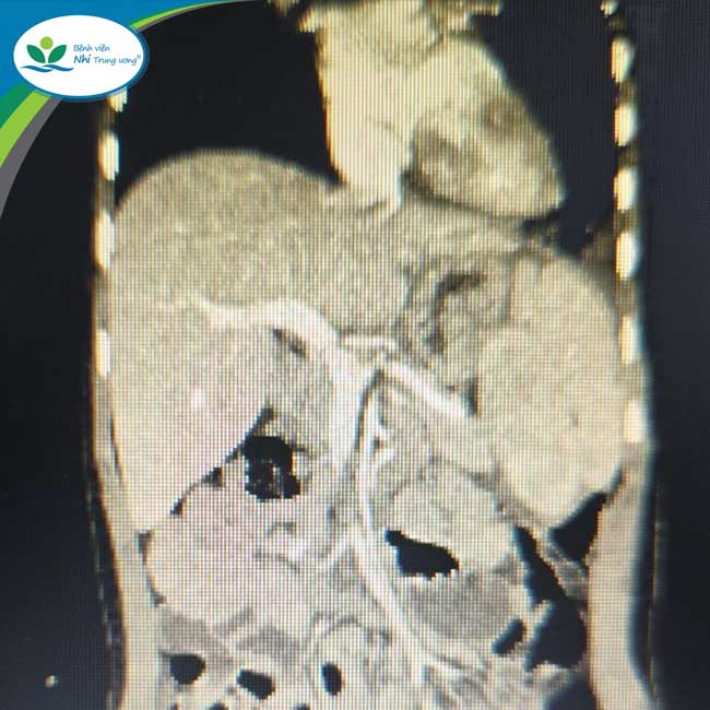 Thận thoát vị trên lồng ngực - Ảnh BVCC