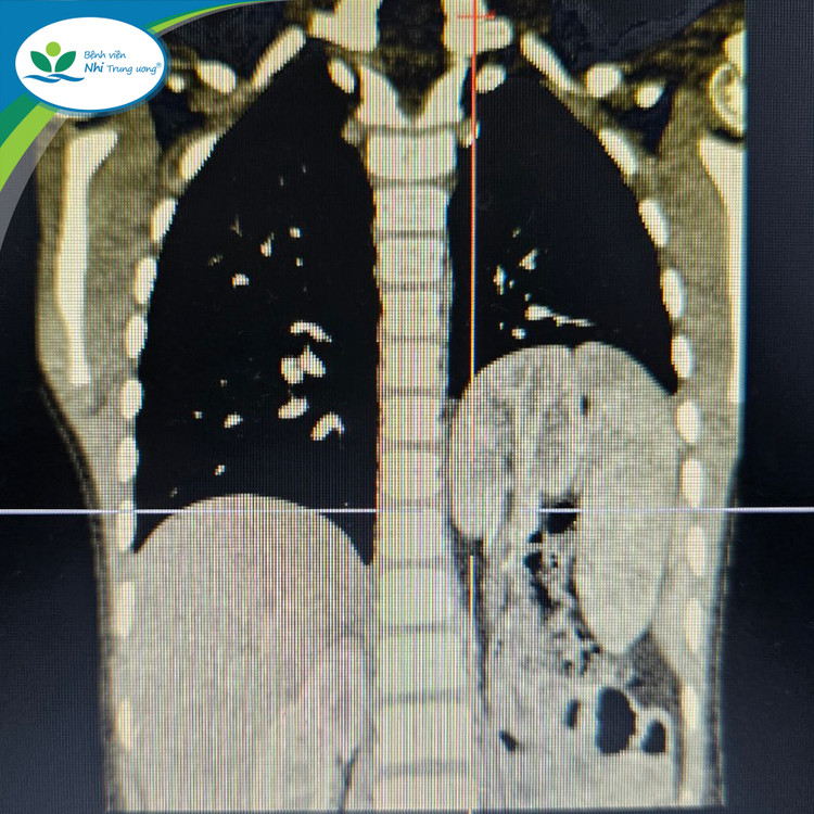 Hình ảnh chụp thoát vị hoành trái bẩm sinh với tạng thoát vị là lách, ruột non, đại tràng và kèm theo thận lạc chỗ trên lồng ngực của trẻ