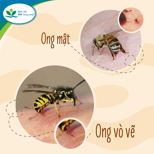 Phân biệt loại ong đốt - Ảnh BV nhi TƯ