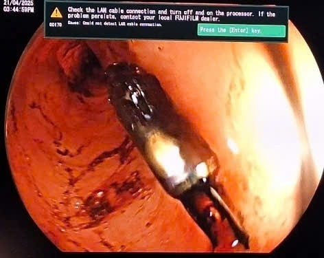 Nội soi lấy dị vật sắc nhọn trong ruột non.