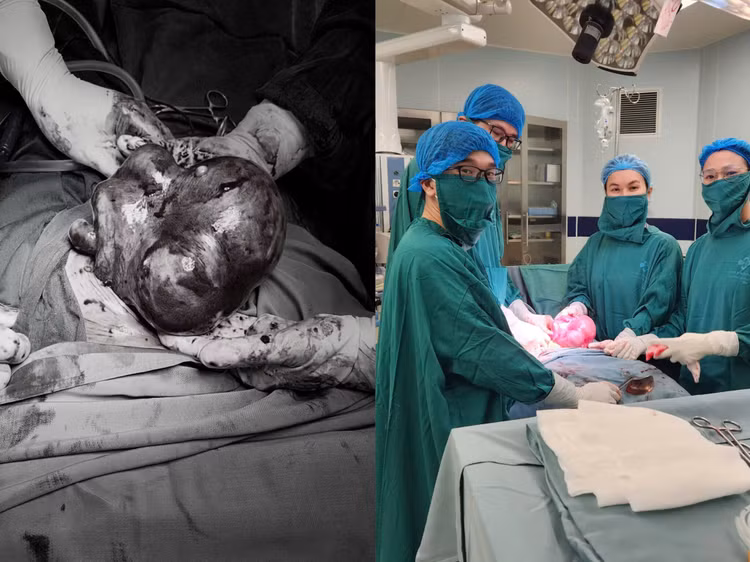 Phẫu thuật lấy khối u xơ tử cung lớn cho bệnh nhân - Ảnh BVCC