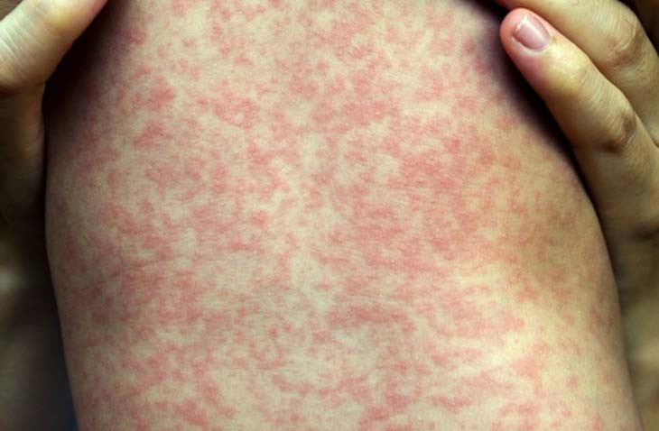 Từ tháng 3 đến nay, khoa Nhi tiếp nhận điều trị gần 40 bệnh nhi mắc sởi - Ảnh BVCC