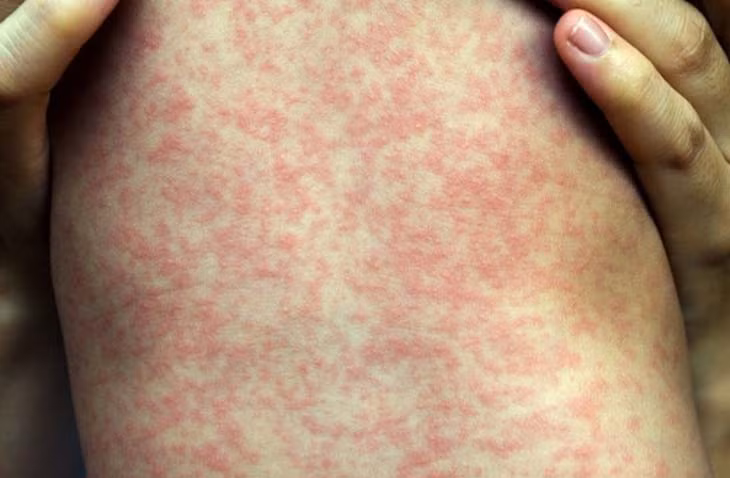 Từ tháng 3 đến nay, khoa Nhi tiếp nhận điều trị gần 40 bệnh nhi mắc sởi - Ảnh BVCC